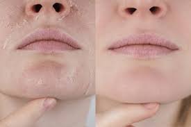 dry skin vs dehydrated skin