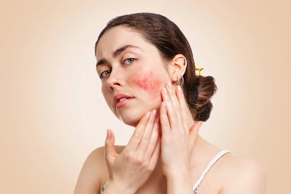 Redness and Rosacea Symptoms