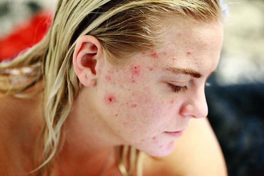 Fights Acne and Controls Excess Oil